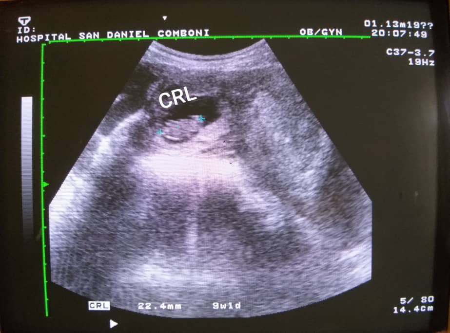 Heterotopic pregnancy: case report of a rare clinical presentation