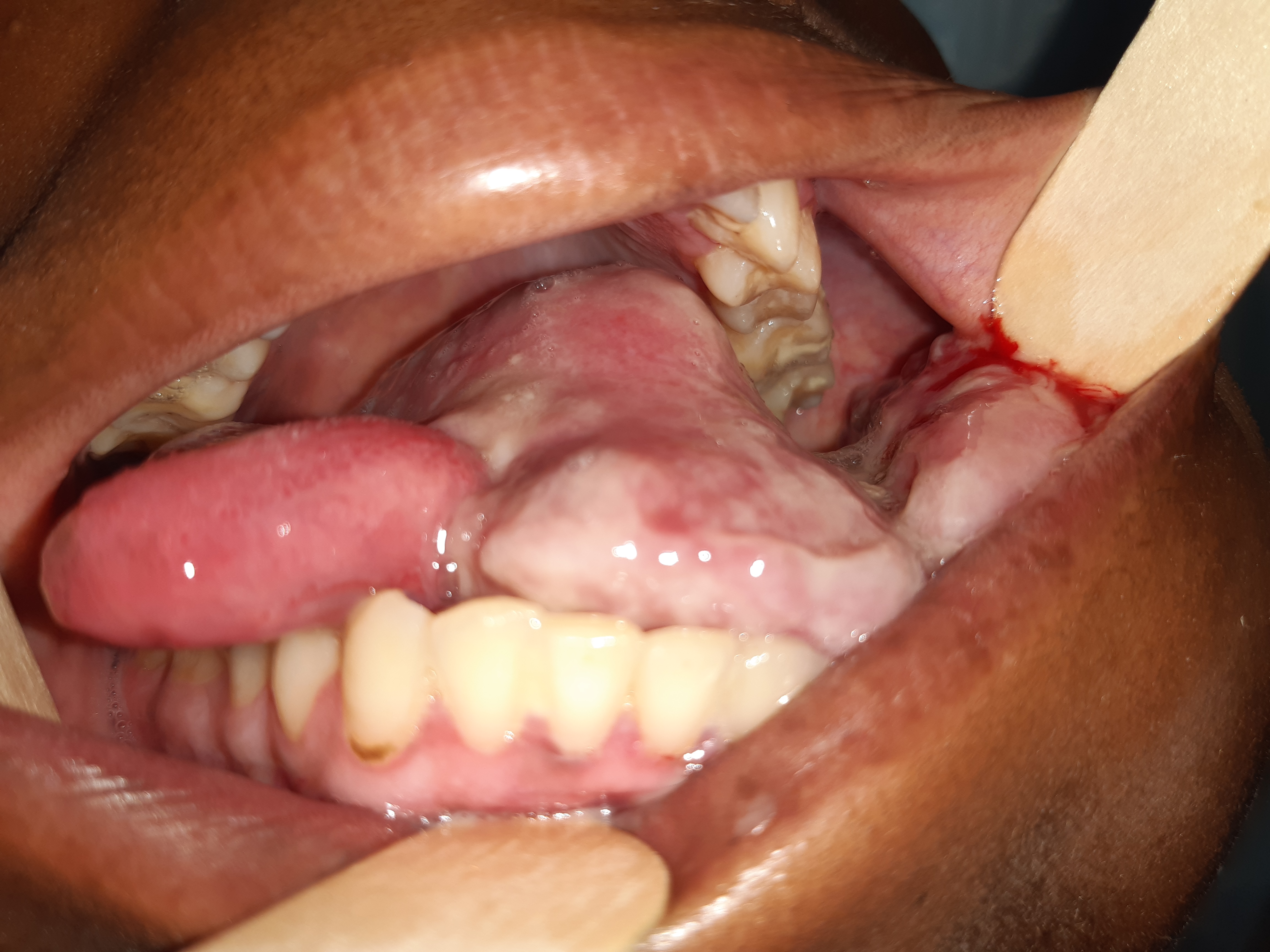 ossifying fibroma oral