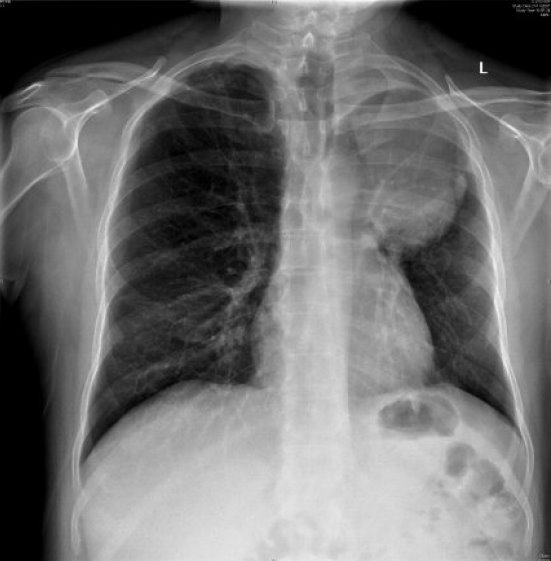 How to Read a Chest X-ray – A Step By Step Approach