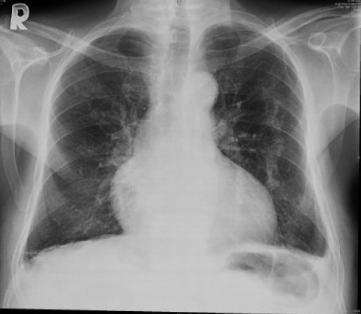asbestos exposure x-ray pictures